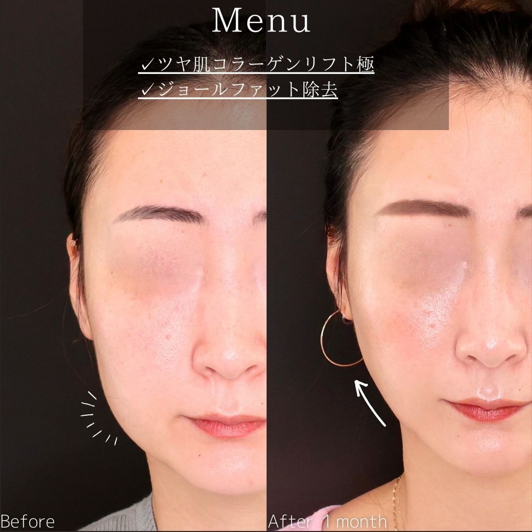 TAC式 ツヤ肌コラーゲンリフト®の症例写真 施術前後 