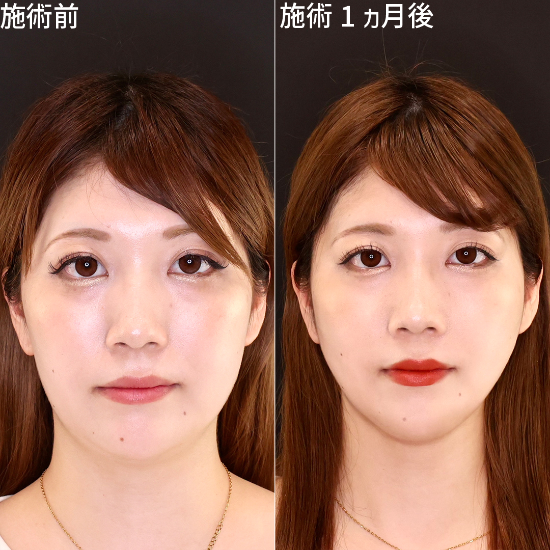 TAC式 ツヤ肌コラーゲンリフト®/顔の脂肪吸引の症例写真 施術前後 