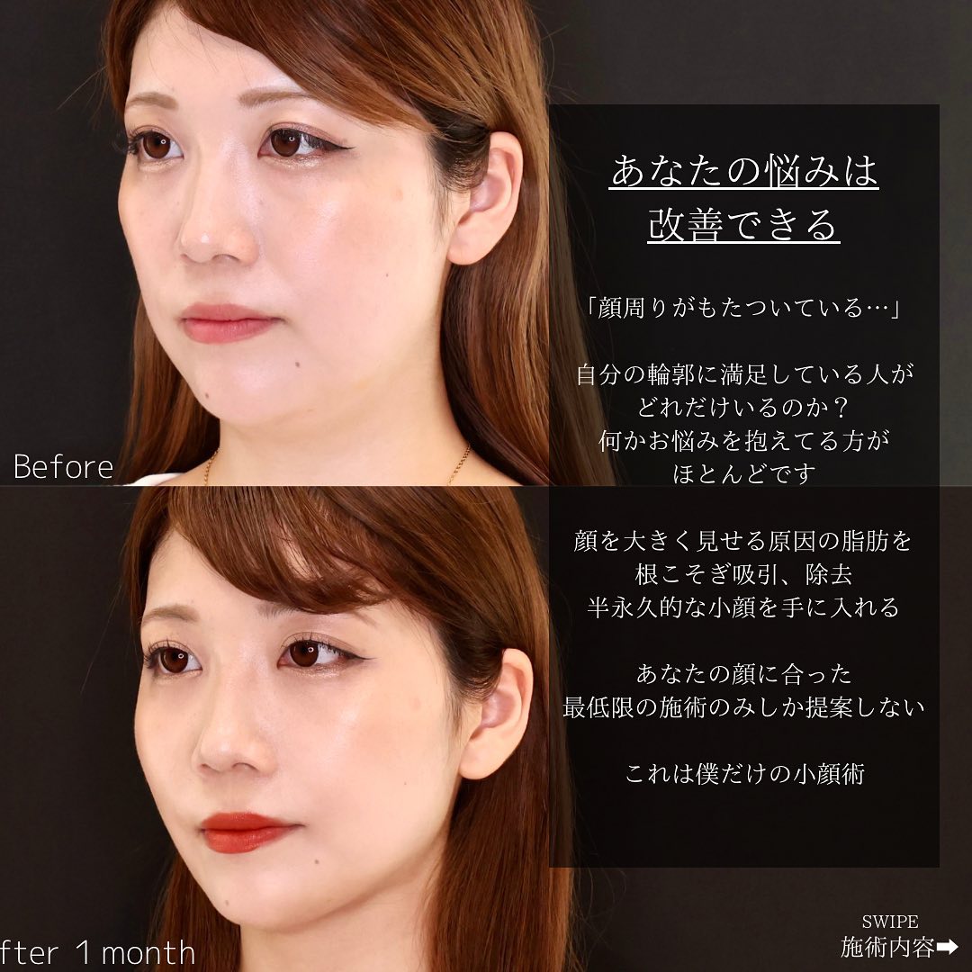 TAC式 ツヤ肌コラーゲンリフト®/顔の脂肪吸引の症例写真 施術前後 