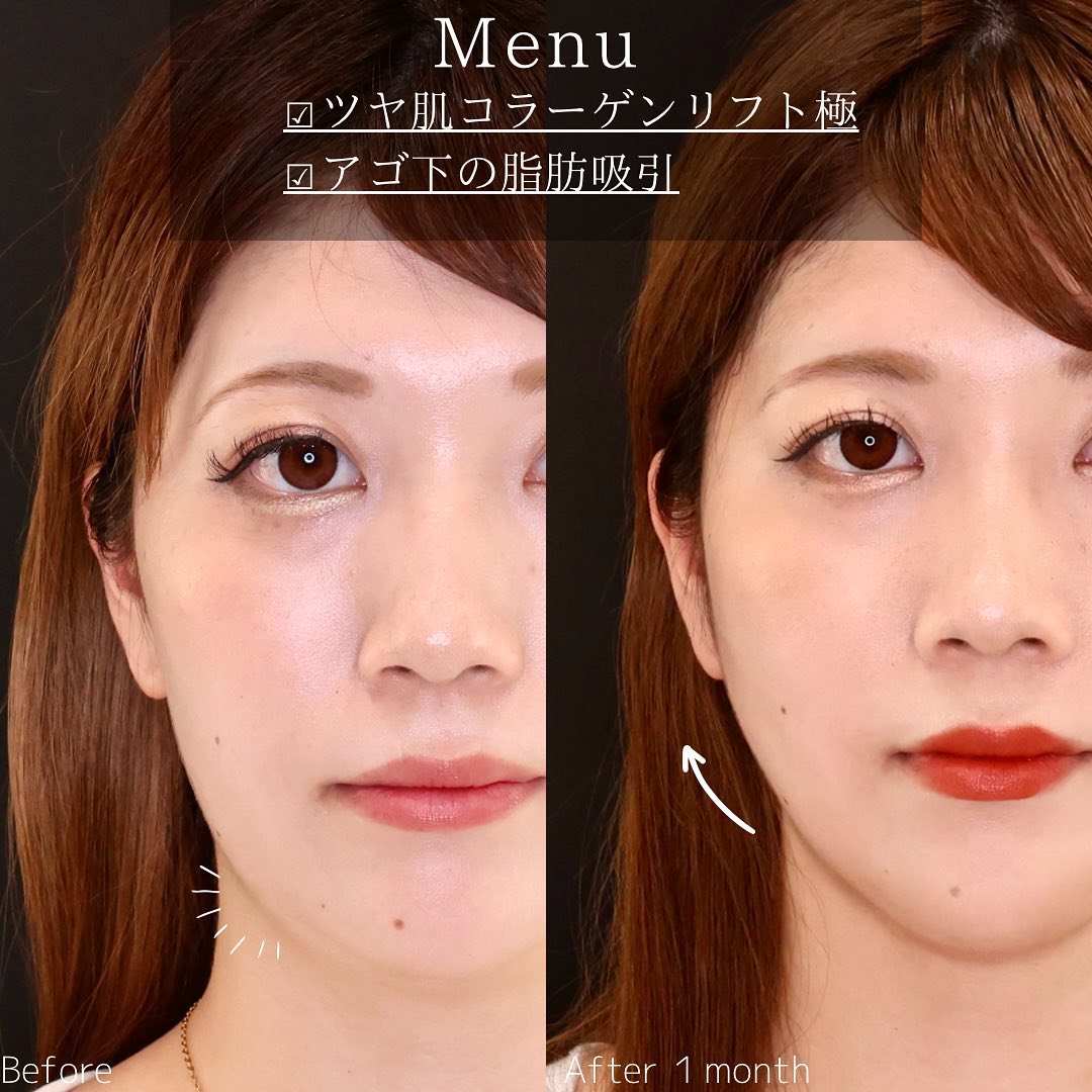 TAC式 ツヤ肌コラーゲンリフト®/顔の脂肪吸引の症例写真 施術前後 