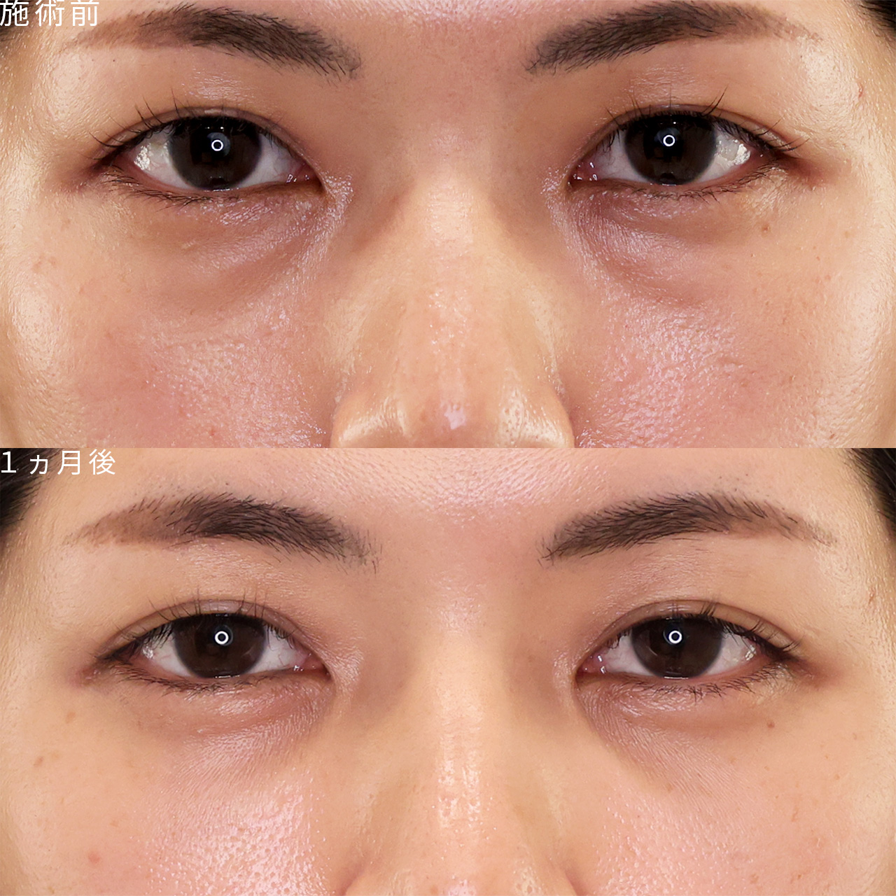 疲れた印象を改善する【クマ取り＋脂肪注入】