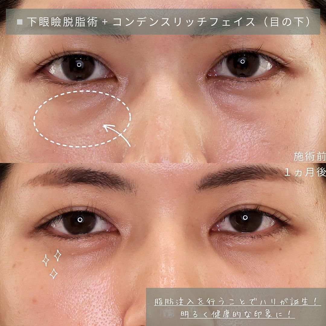 下眼瞼切開術（クマ・たるみとり）/顔の脂肪注入(コンデンスリッチフェイス)の症例写真 施術前後 