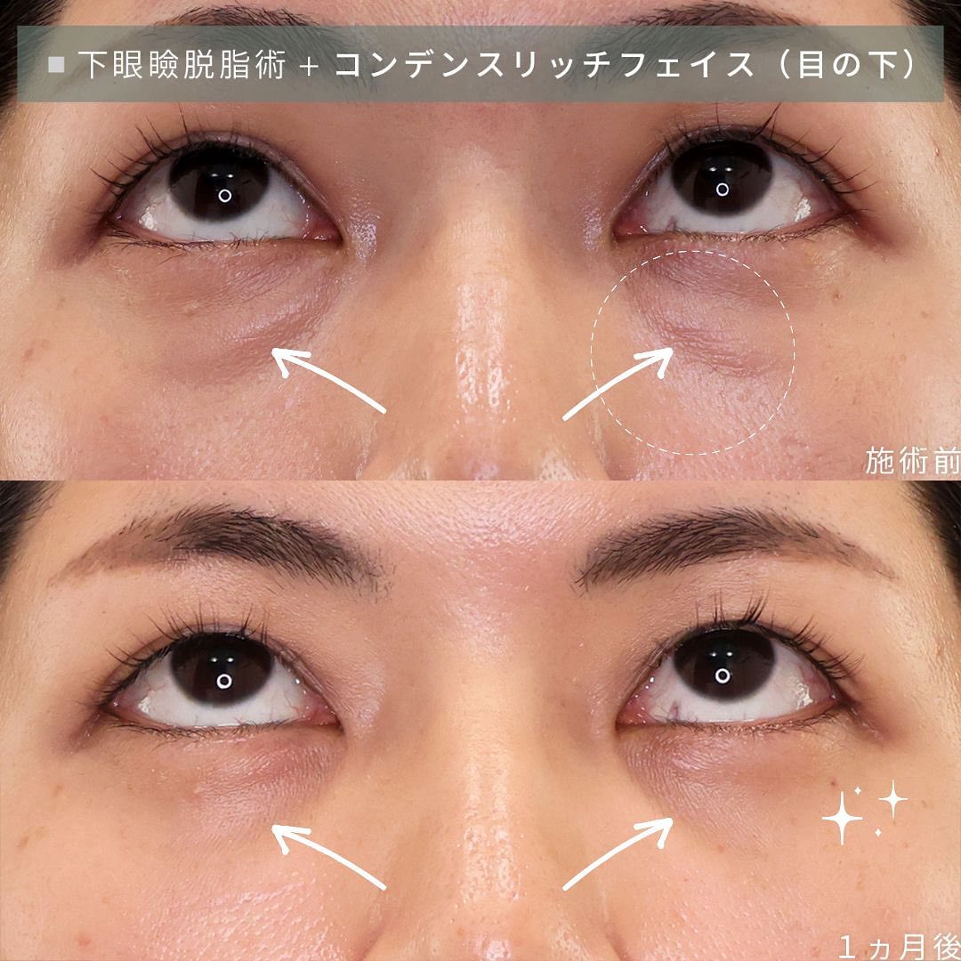 下眼瞼切開術（クマ・たるみとり）/顔の脂肪注入(コンデンスリッチフェイス)の症例写真 施術前後 
