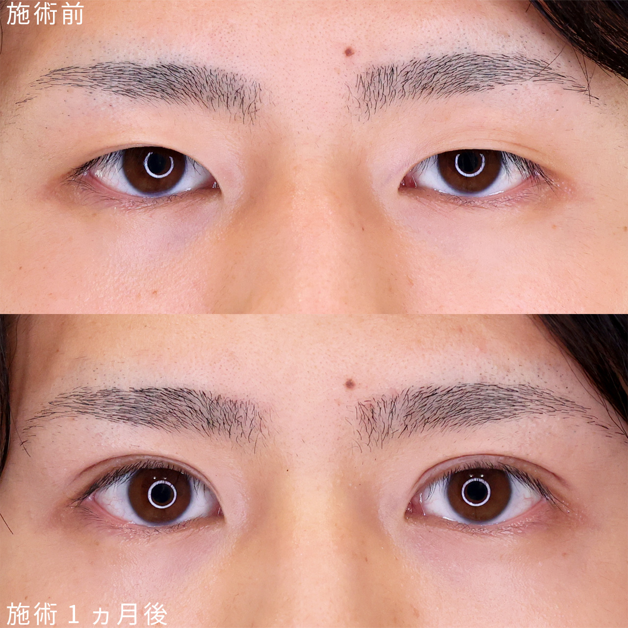 眼瞼下垂 手術 20代の症例写真・画像・ビフォーアフター｜美容