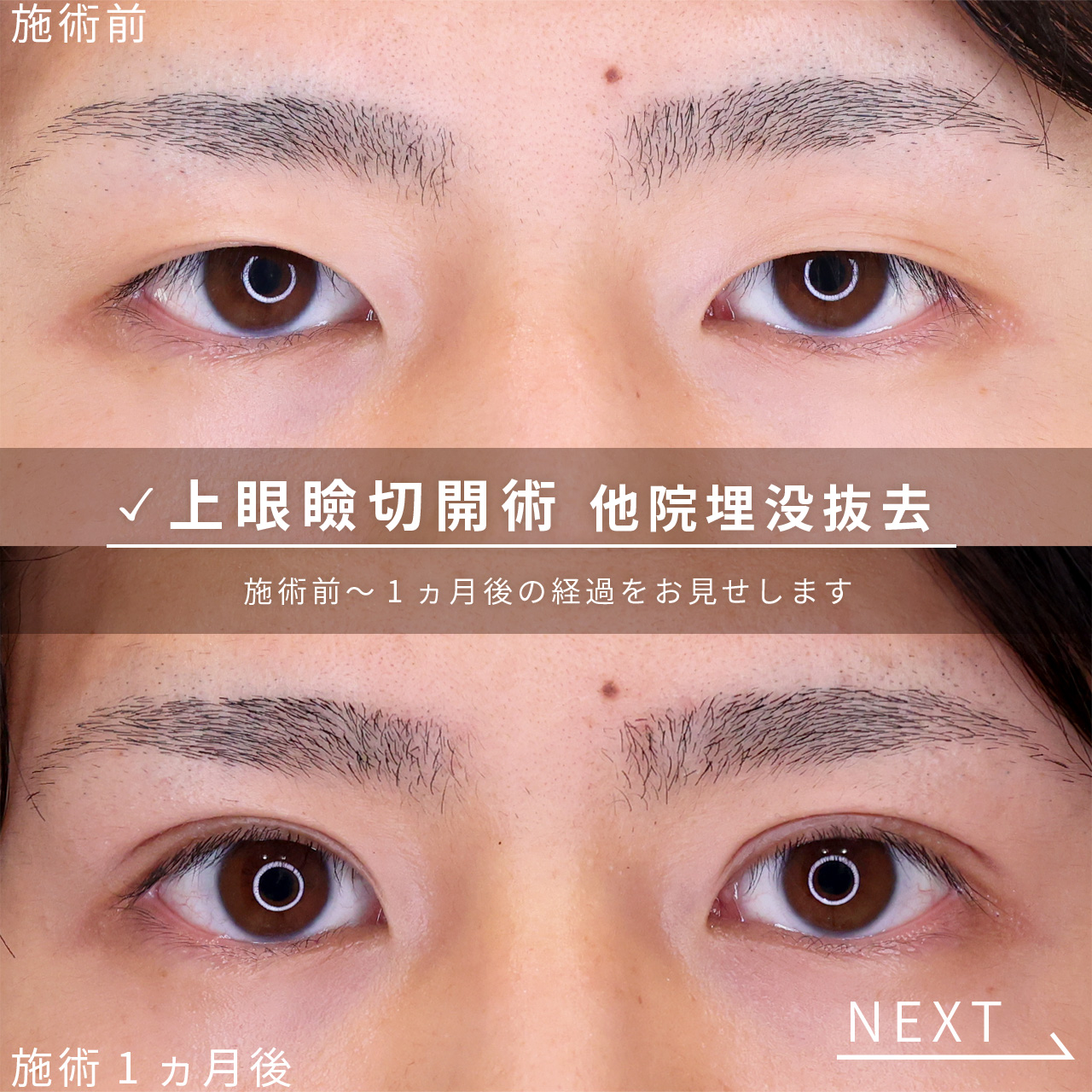 上眼瞼切開術の症例写真 施術前後 