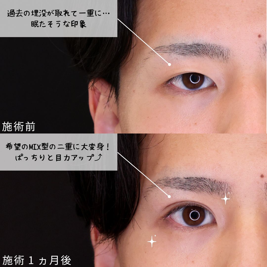 上眼瞼切開術の症例写真 施術前後 