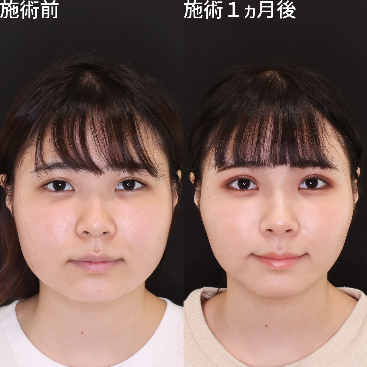 【糸リフト+脂肪吸引】Dr.石橋の脱・丸顔術