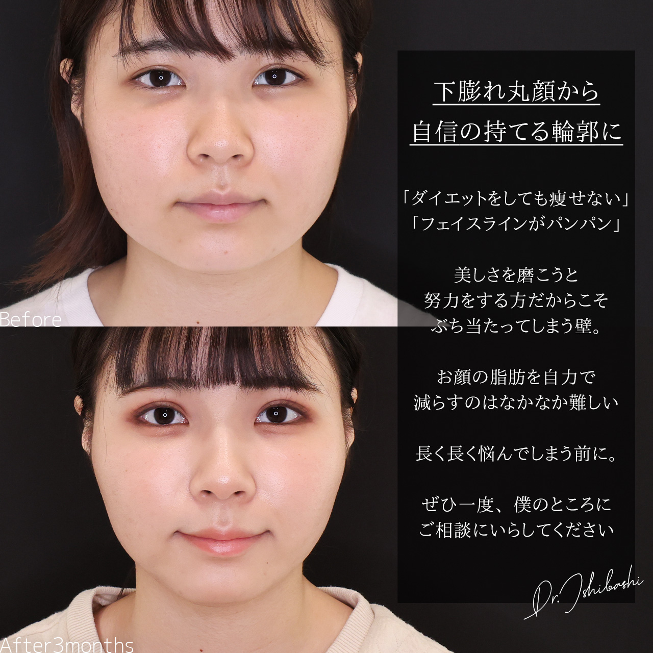 TAC式 ツヤ肌コラーゲンリフト®/顎下の脂肪吸引/エラボトックス注射の症例写真 施術前後 