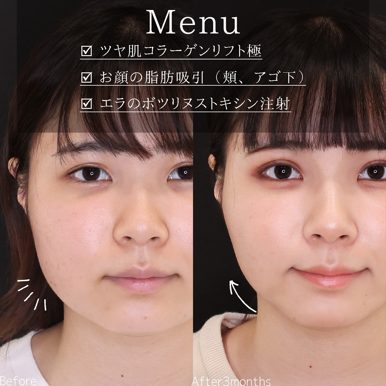 TAC式 ツヤ肌コラーゲンリフト®/顎下の脂肪吸引/エラボトックス注射の症例写真 施術前後 