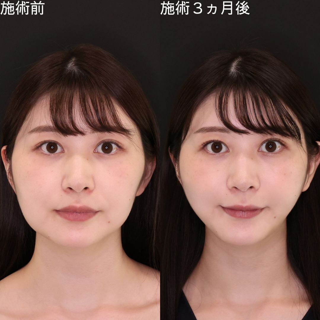 TAC式 ツヤ肌コラーゲンリフト®の症例写真 施術前後 