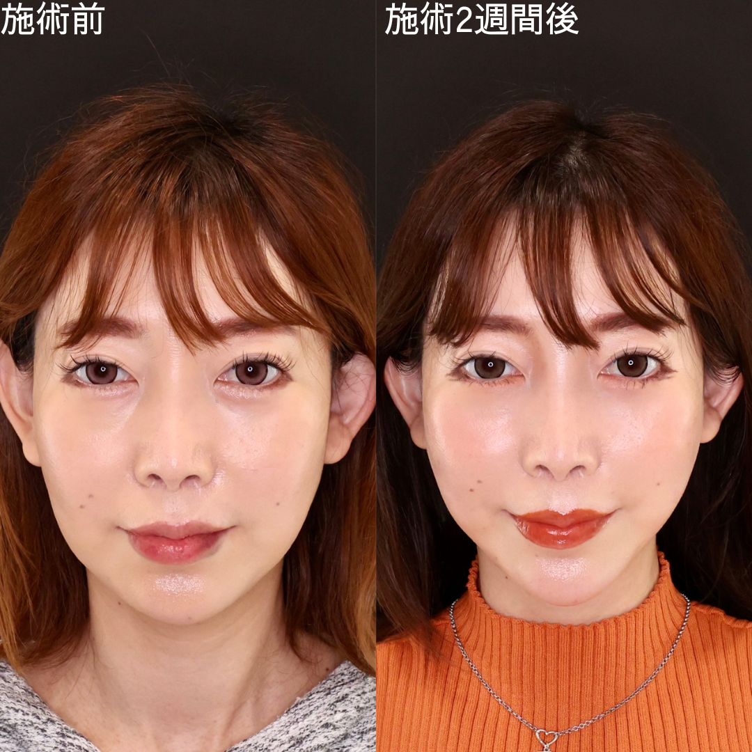 15分で弛み０に！即日小顔術【糸リフト】