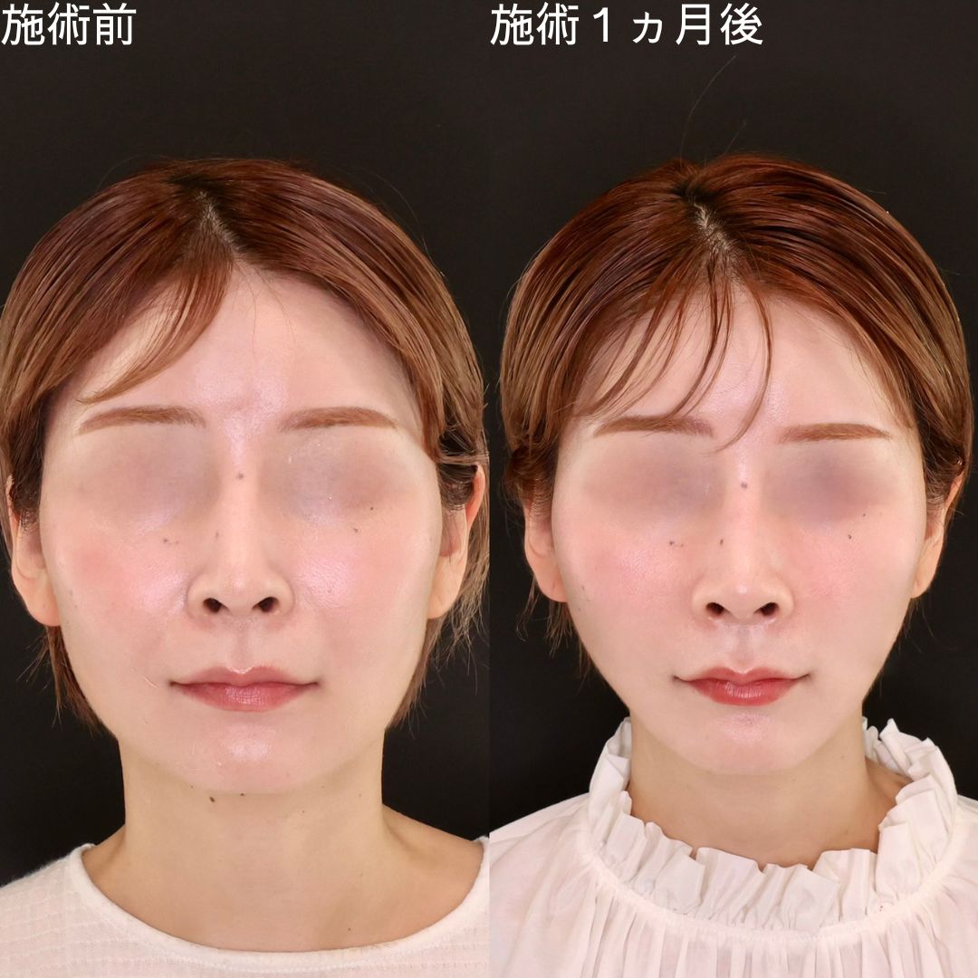 たった１施術で即日小顔に【糸リフト】