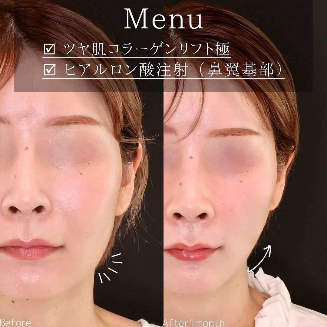 TAC式 ツヤ肌コラーゲンリフト®/ヒアルロン酸注射：その他の症例写真 施術前後 