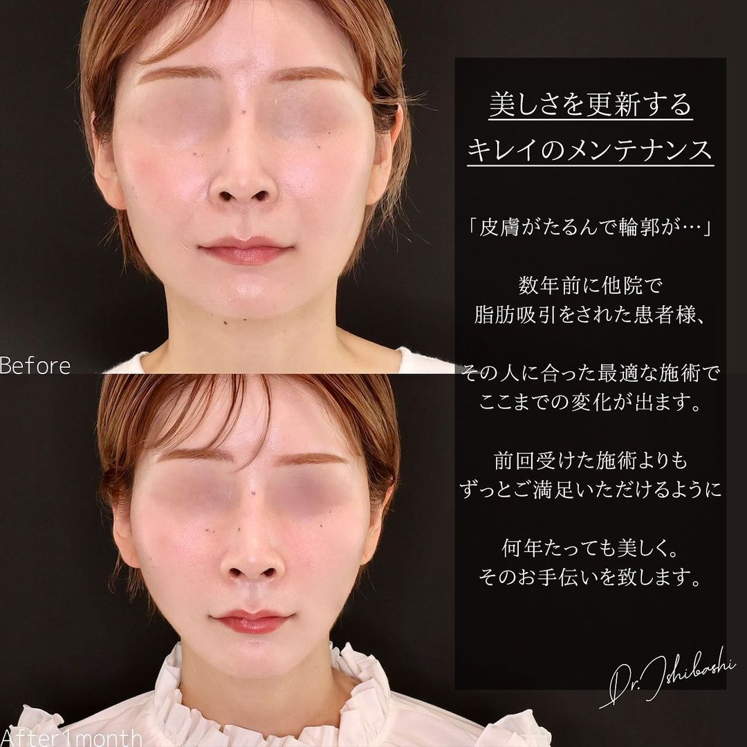 TAC式 ツヤ肌コラーゲンリフト®/ヒアルロン酸注射：その他の症例写真 施術前後 