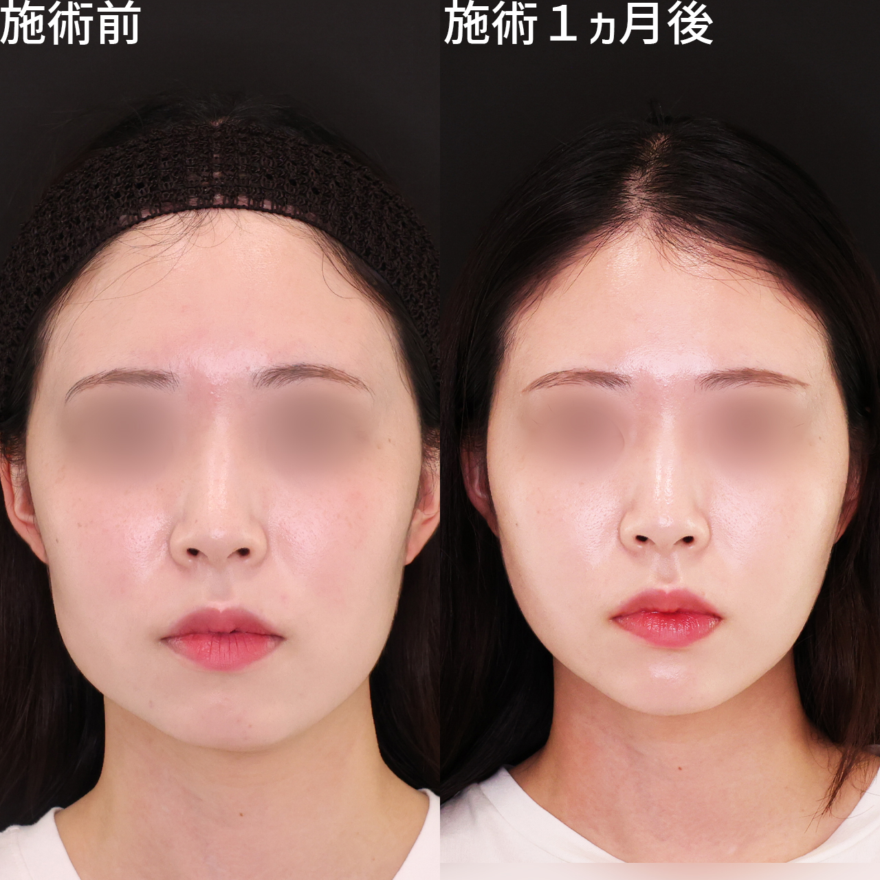 口横のもたつきをスッキリ。印象激変小顔