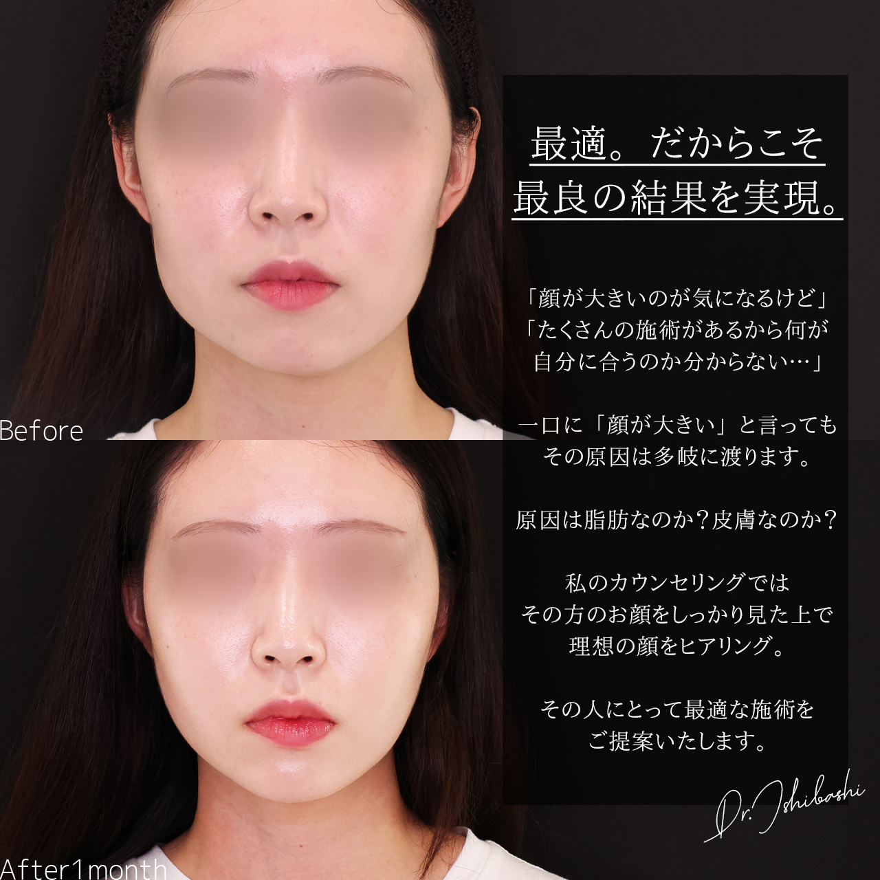 ジョールファット除去/TAC式 ツヤ肌コラーゲンリフト®/顎のヒアルロン酸注射の症例写真 施術前後 