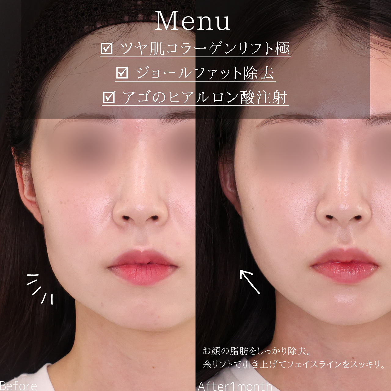 ジョールファット除去/TAC式 ツヤ肌コラーゲンリフト®/顎のヒアルロン酸注射の症例写真 施術前後 