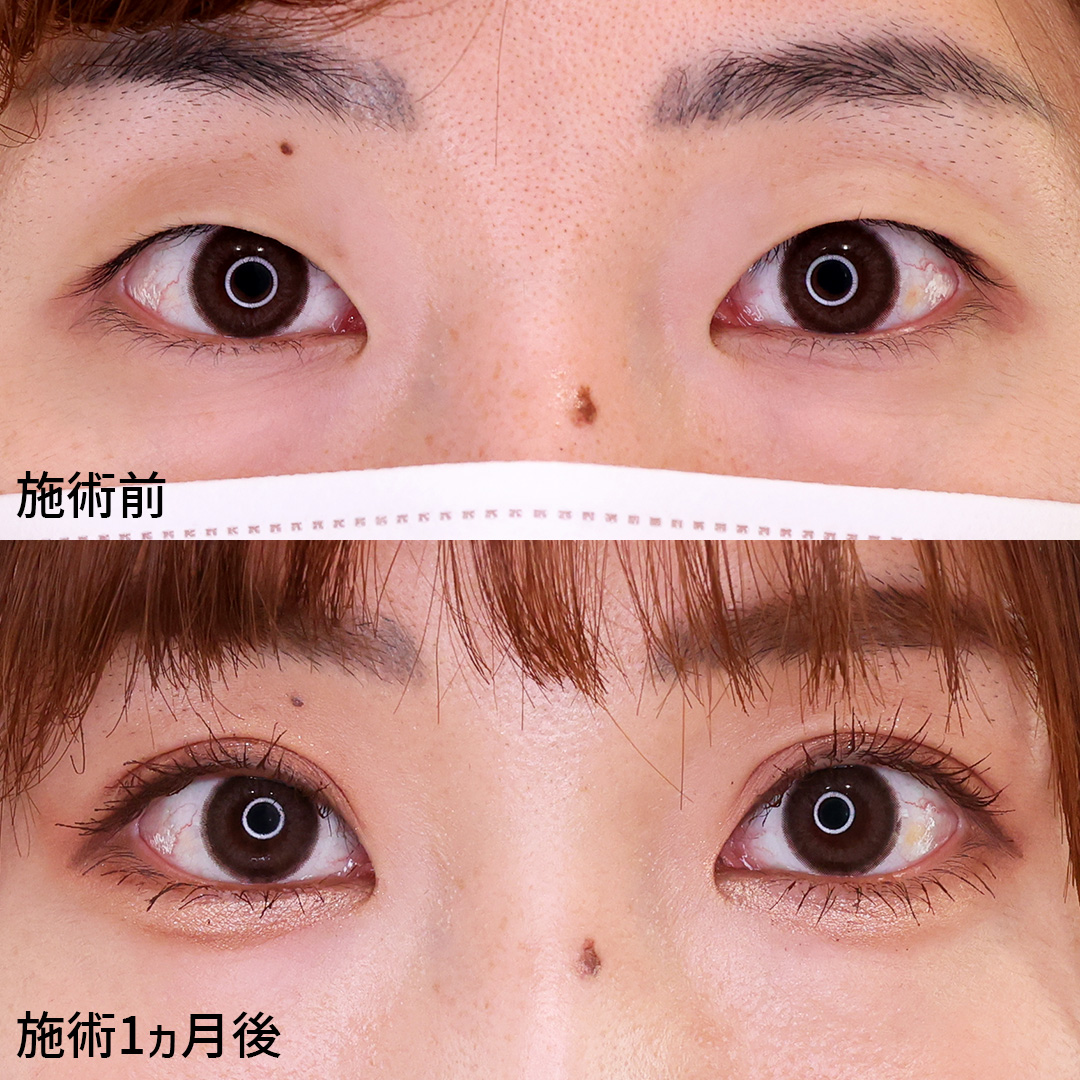 二重埋没法の症例写真 施術前後 