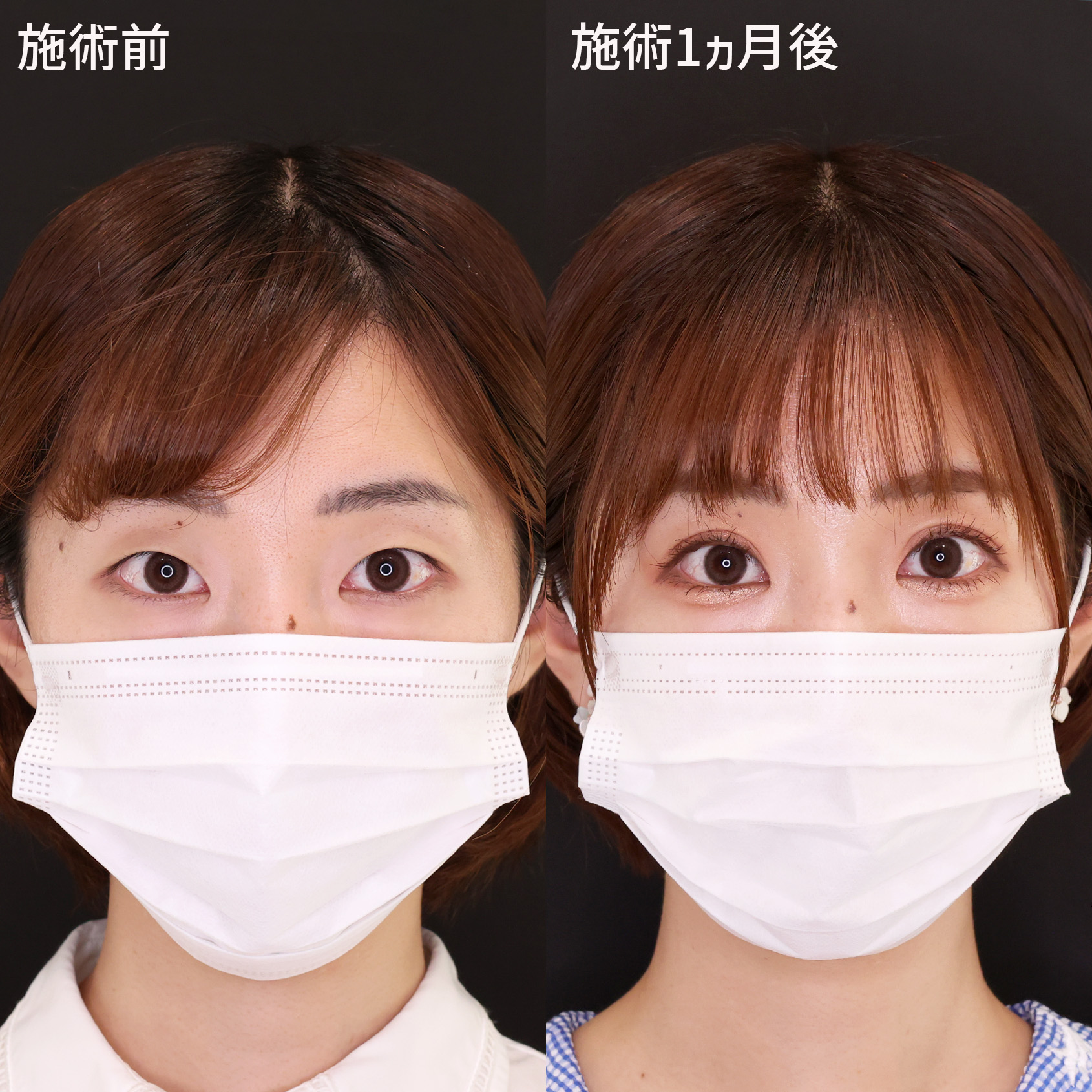 二重埋没法の症例写真 施術前後 