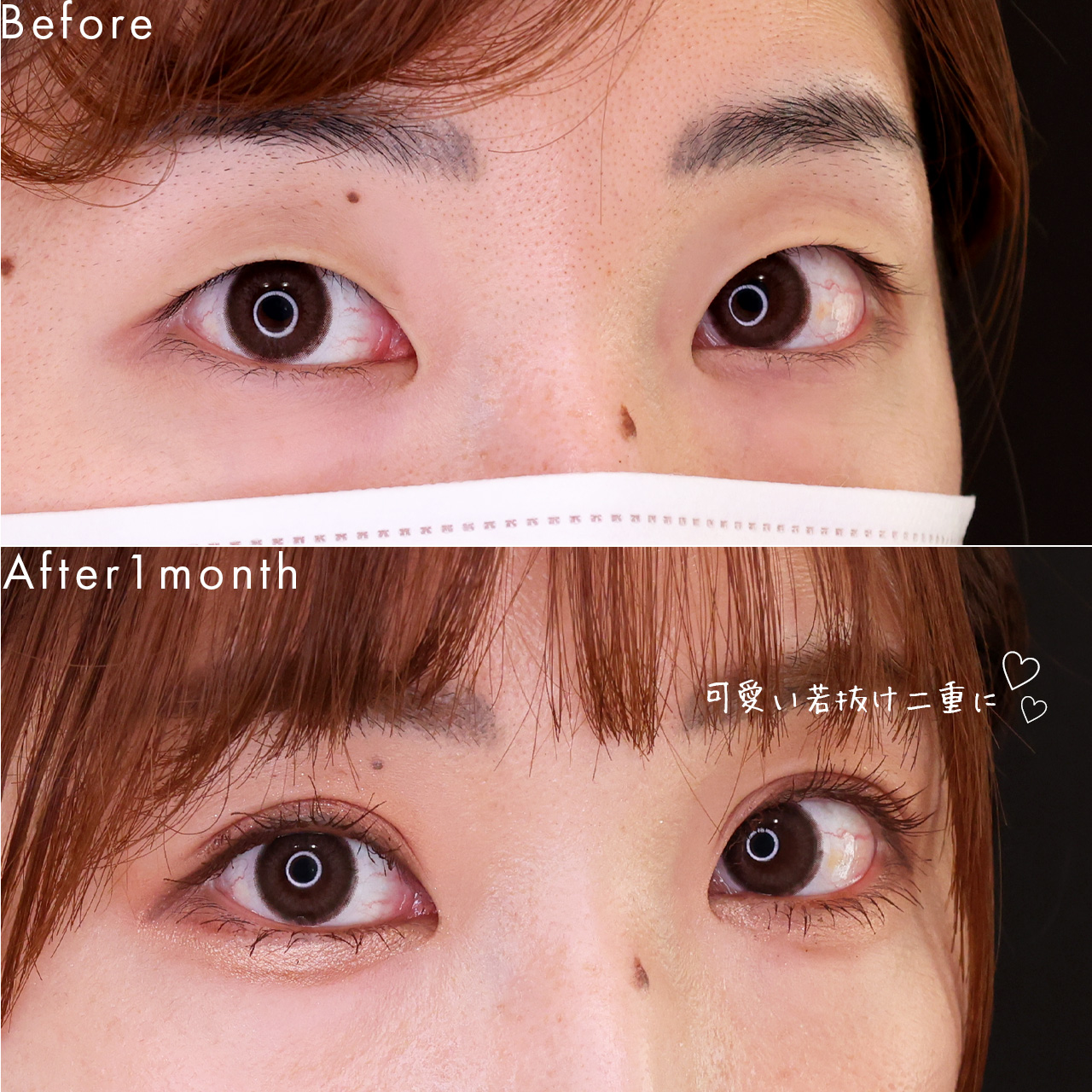 二重埋没法の症例写真 施術前後 