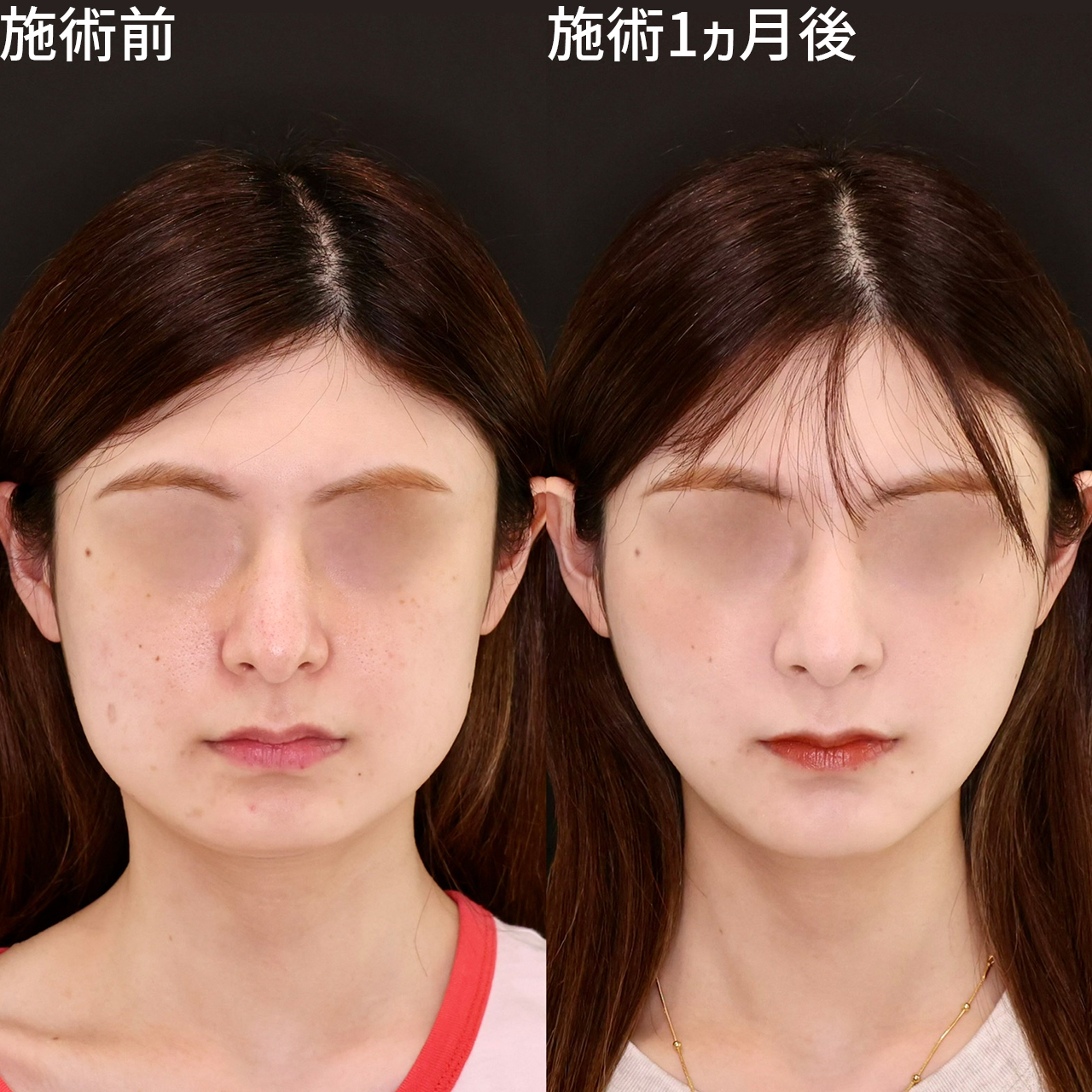 下膨れ顏解消。大人っぽく垢抜けた輪郭に