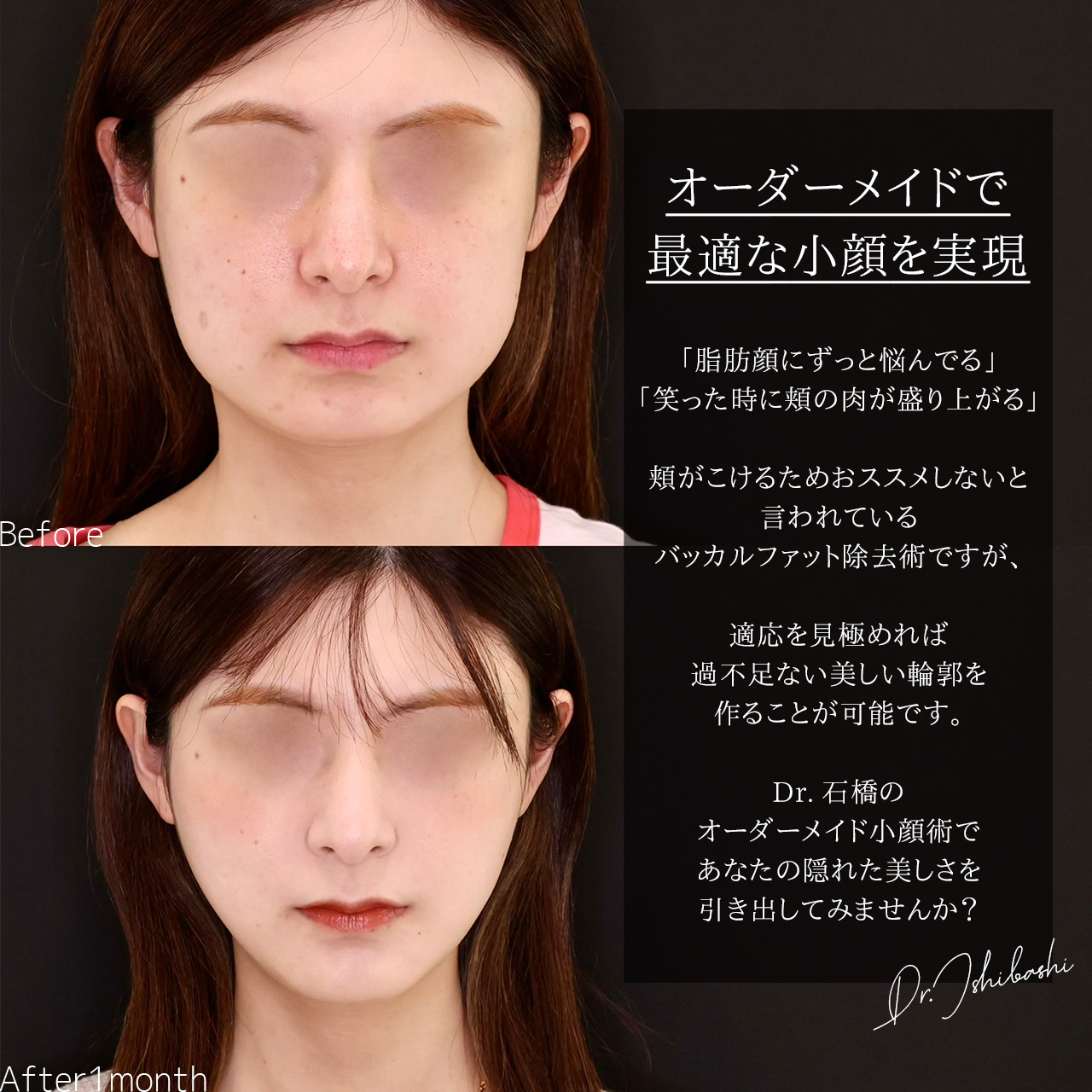 TAC式 ツヤ肌コラーゲンリフト®/バッカルファット除去の症例写真 施術前後 