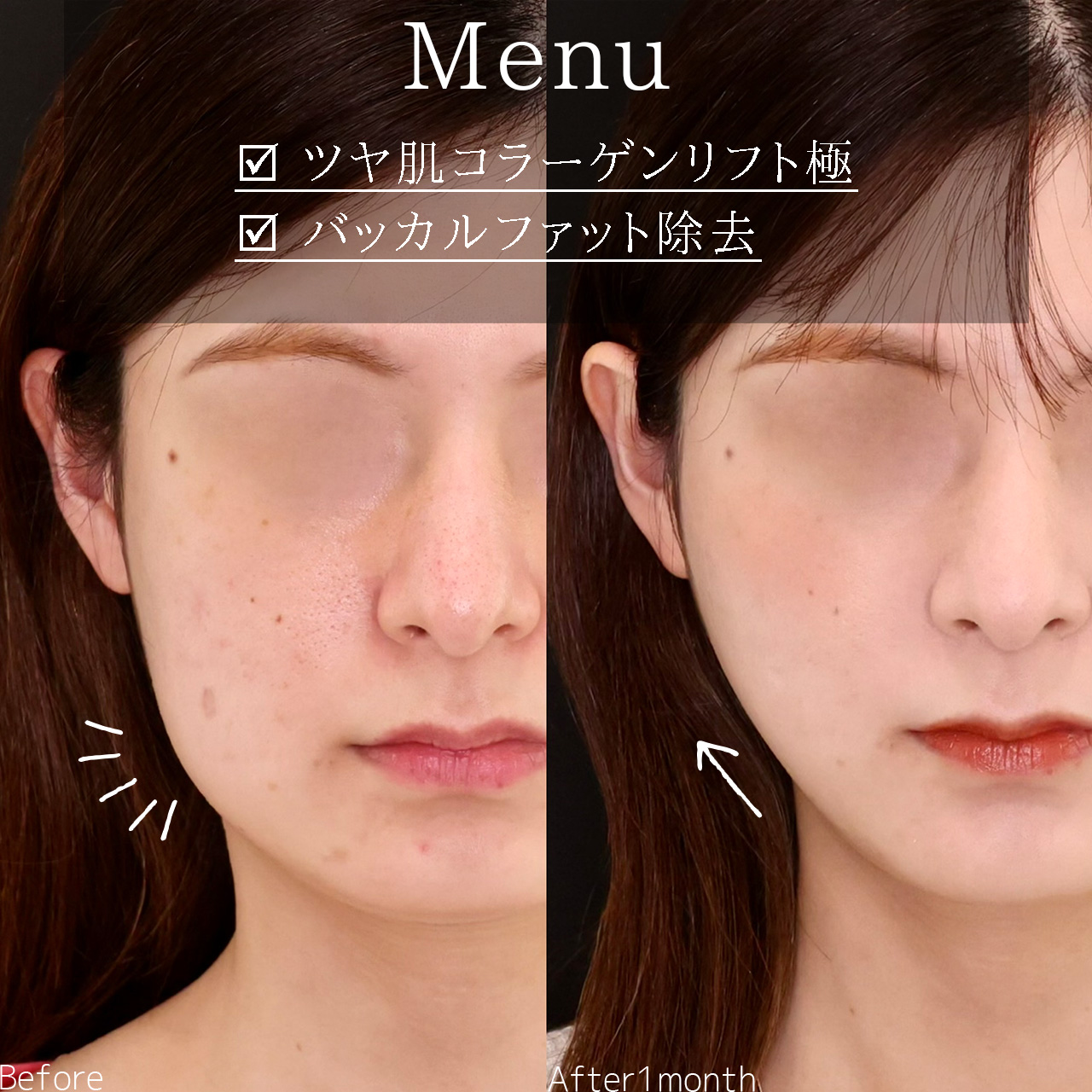 TAC式 ツヤ肌コラーゲンリフト®/バッカルファット除去の症例写真 施術前後 