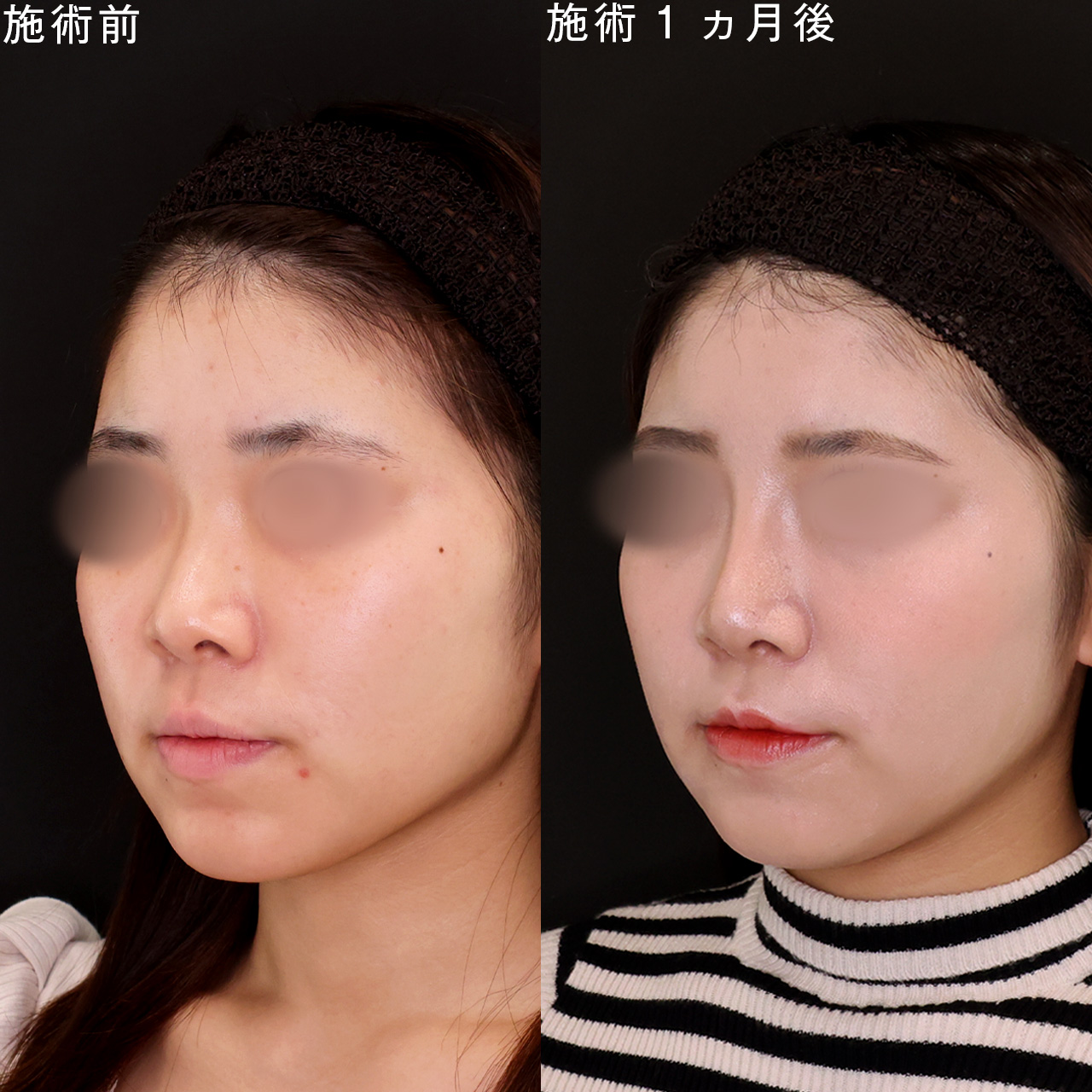 鼻筋を高くしてナチュラルに垢抜ける【鼻整形】