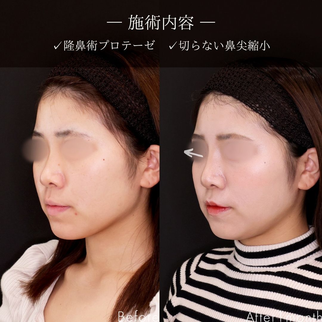 隆鼻術（プロテーゼ・自家組織）/鼻尖形成・鼻尖縮小の症例写真 施術前後 