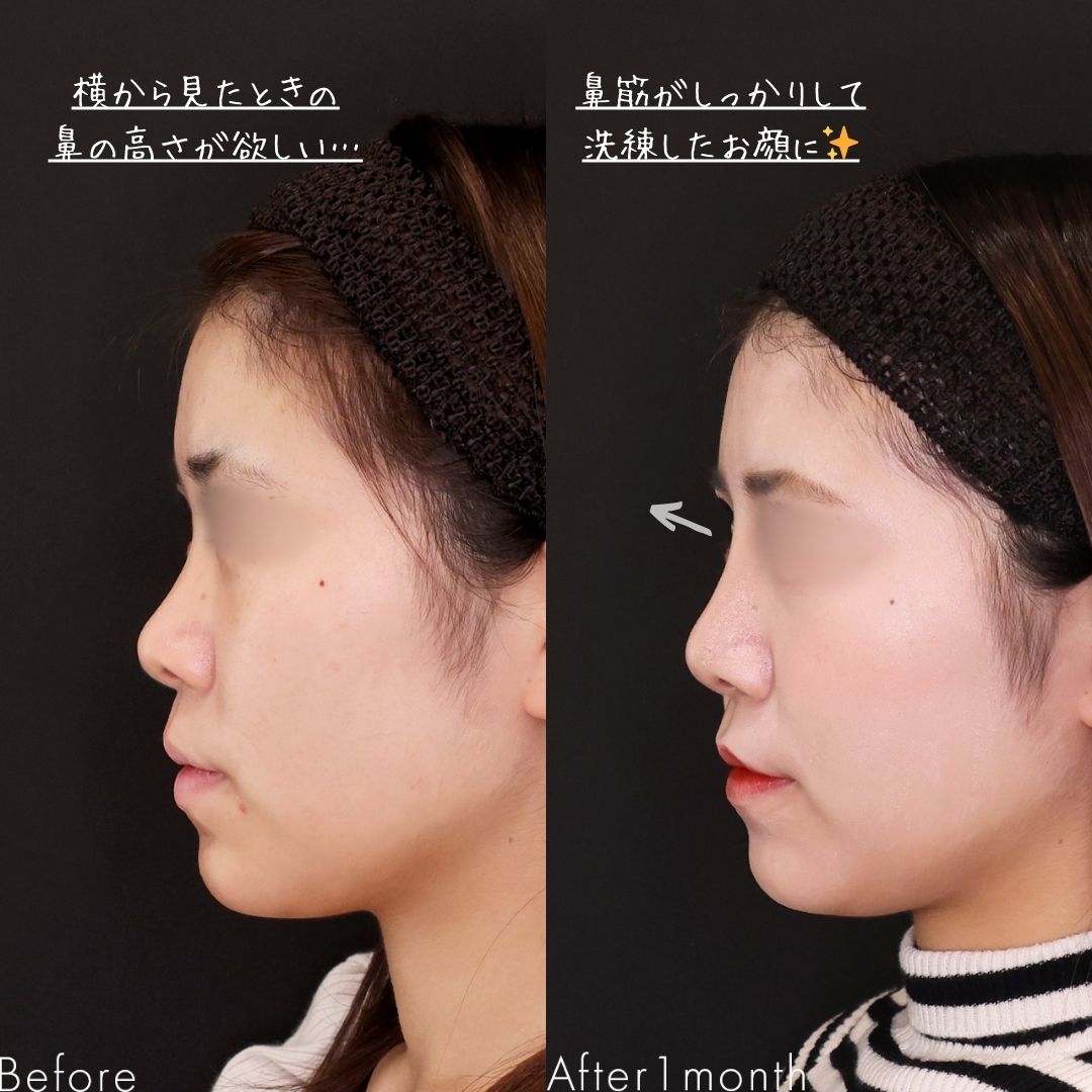 隆鼻術（プロテーゼ・自家組織）/鼻尖形成・鼻尖縮小の症例写真 施術前後 