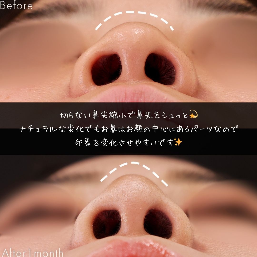 隆鼻術（プロテーゼ・自家組織）/鼻尖形成・鼻尖縮小の症例写真 施術前後 