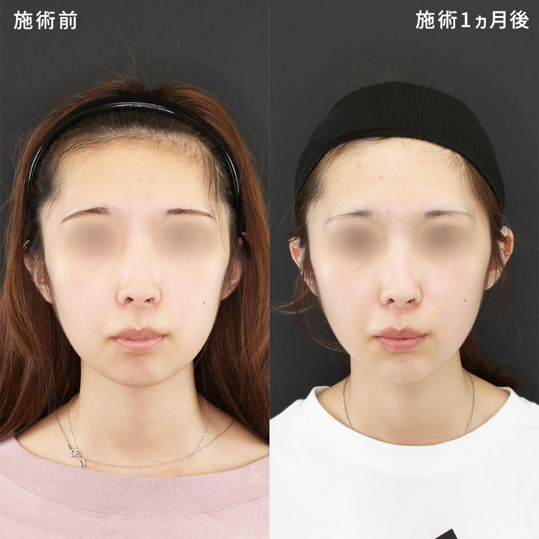 憧れのV字フェイスラインに◎