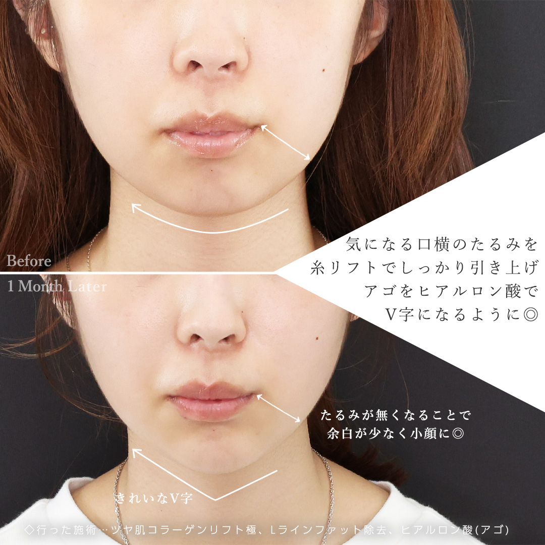 TAC式 ツヤ肌コラーゲンリフト®/Lラインファット除去（エラ下脂肪除去）/顎のヒアルロン酸注射の症例写真 施術前後 