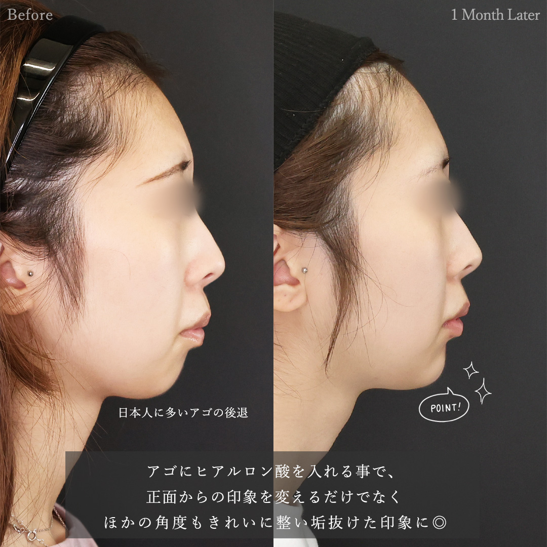TAC式 ツヤ肌コラーゲンリフト®/Lラインファット除去（エラ下脂肪除去）/顎のヒアルロン酸注射の症例写真 施術前後 