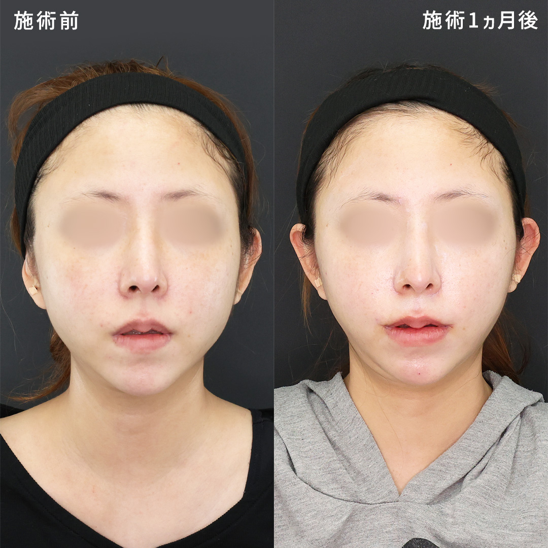 小顔施術×セクシーリップ【M字リップ形成】