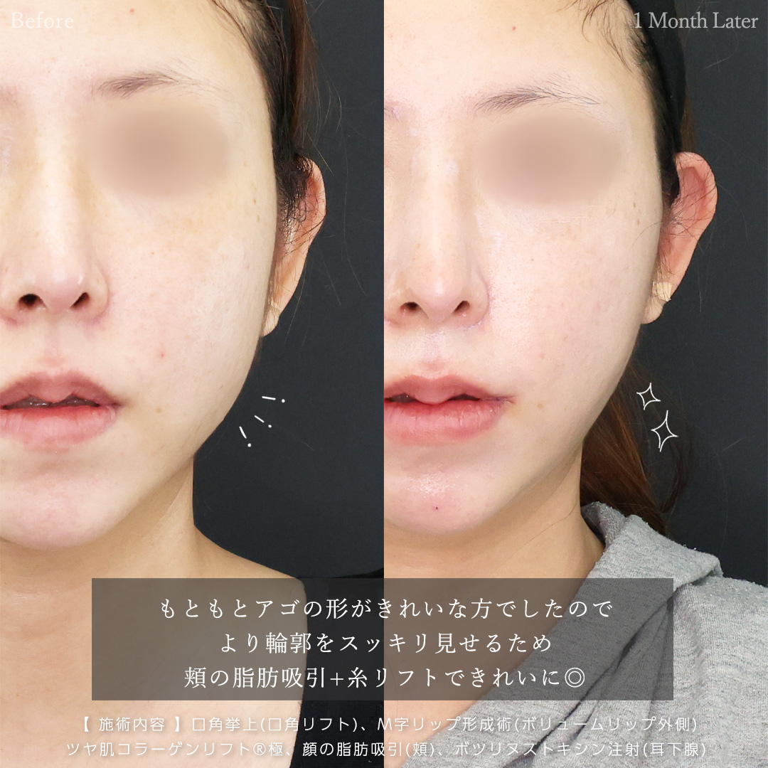 M字リップ形成術/口角挙上・リフト（マイクロ切開法・内側法/口内法）/TAC式 ツヤ肌コラーゲンリフト®の症例写真 施術前後 