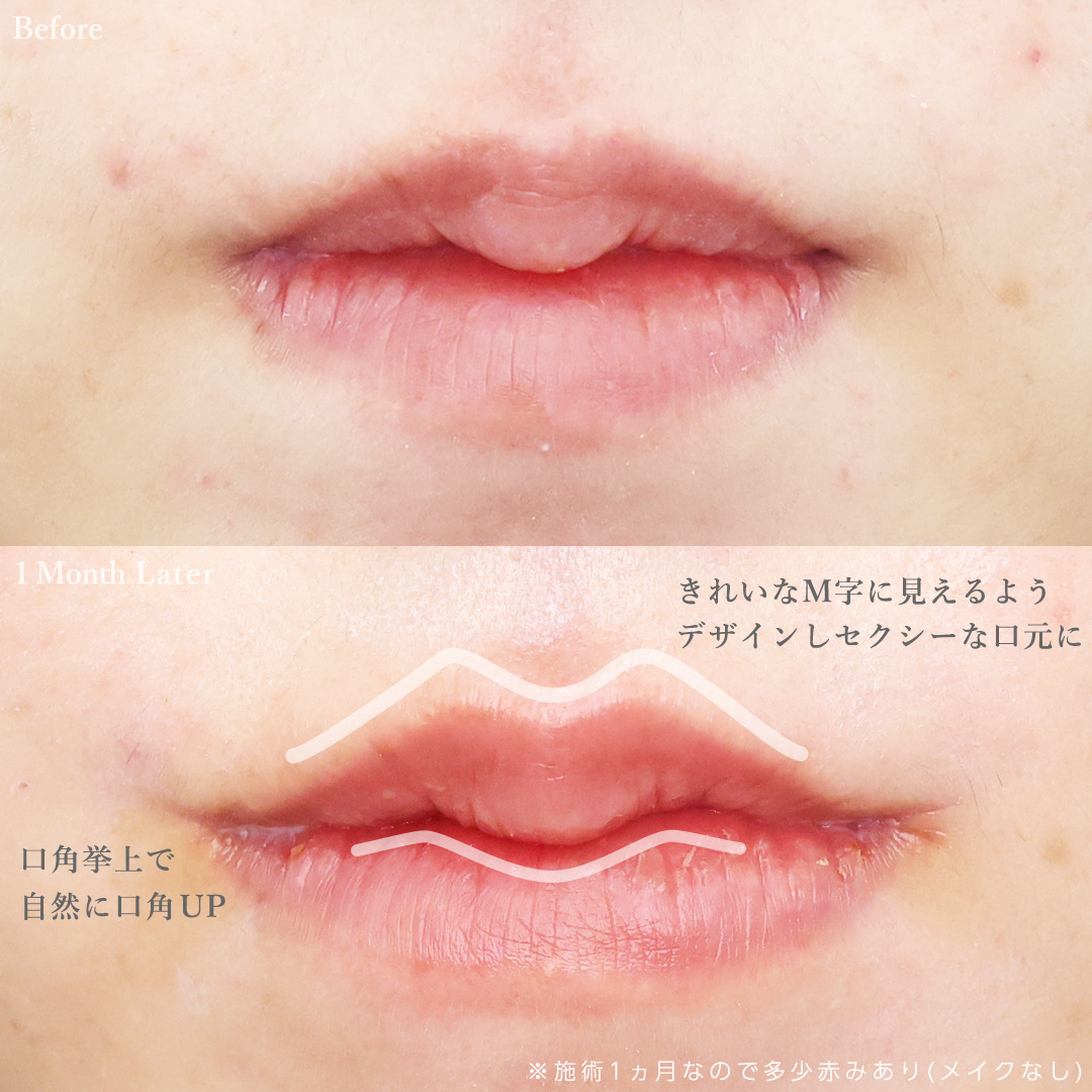 M字リップ形成術/口角挙上・リフト（マイクロ切開法・内側法/口内法）/TAC式 ツヤ肌コラーゲンリフト®の症例写真 施術前後 