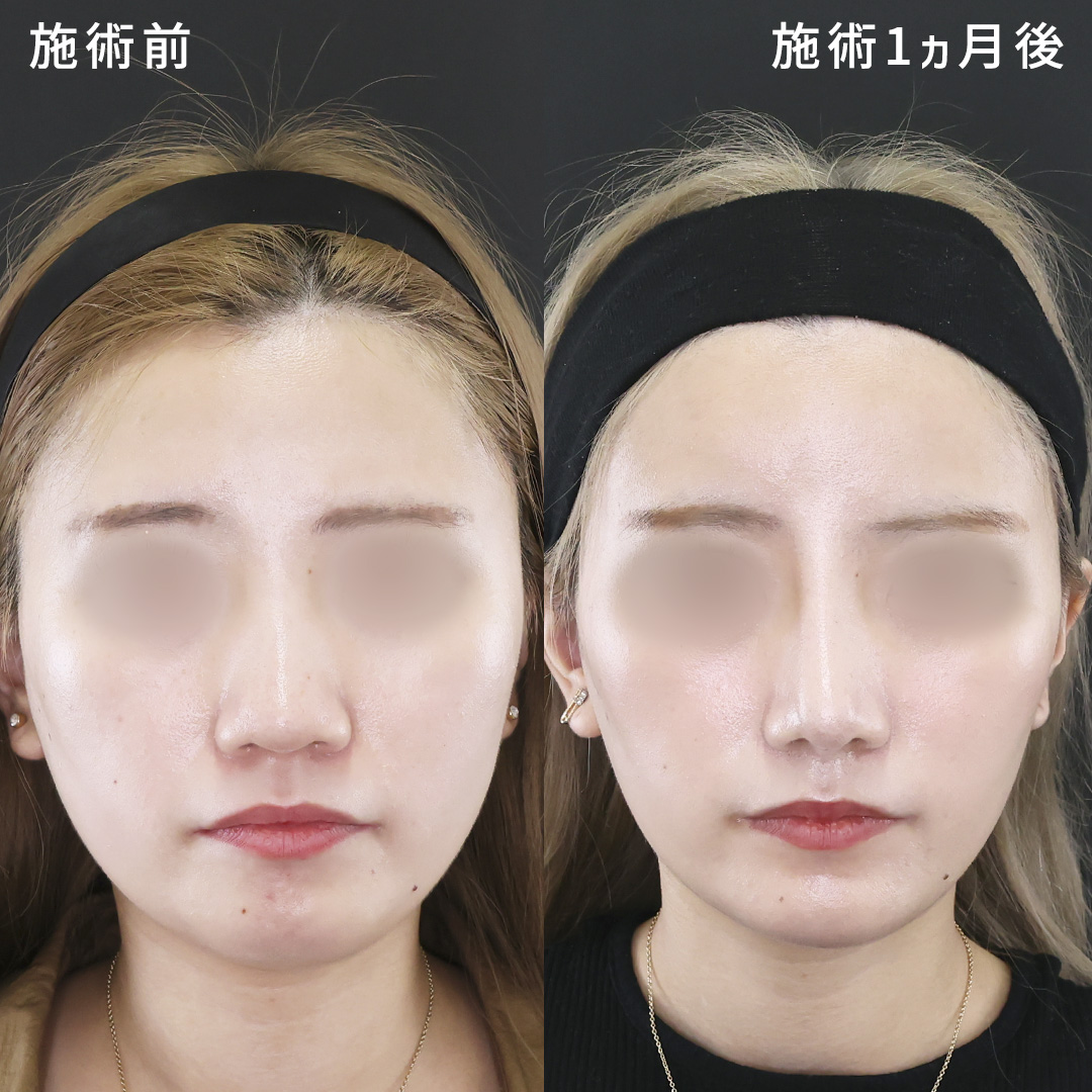 《脂肪注入＆鼻整形》丸いおでこと忘れ鼻を形成｜他院修正