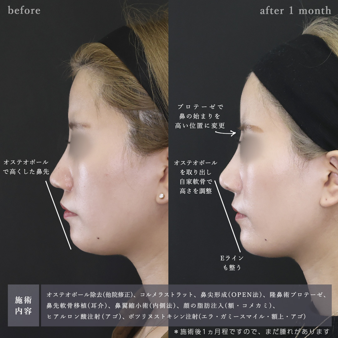 鼻尖形成・鼻尖縮小/鼻先軟骨移植/隆鼻術（プロテーゼ・自家組織）の症例写真 施術前後 