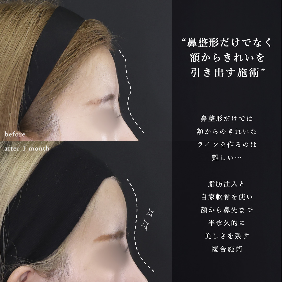 鼻尖形成・鼻尖縮小/鼻先軟骨移植/隆鼻術（プロテーゼ・自家組織）の症例写真 施術前後 