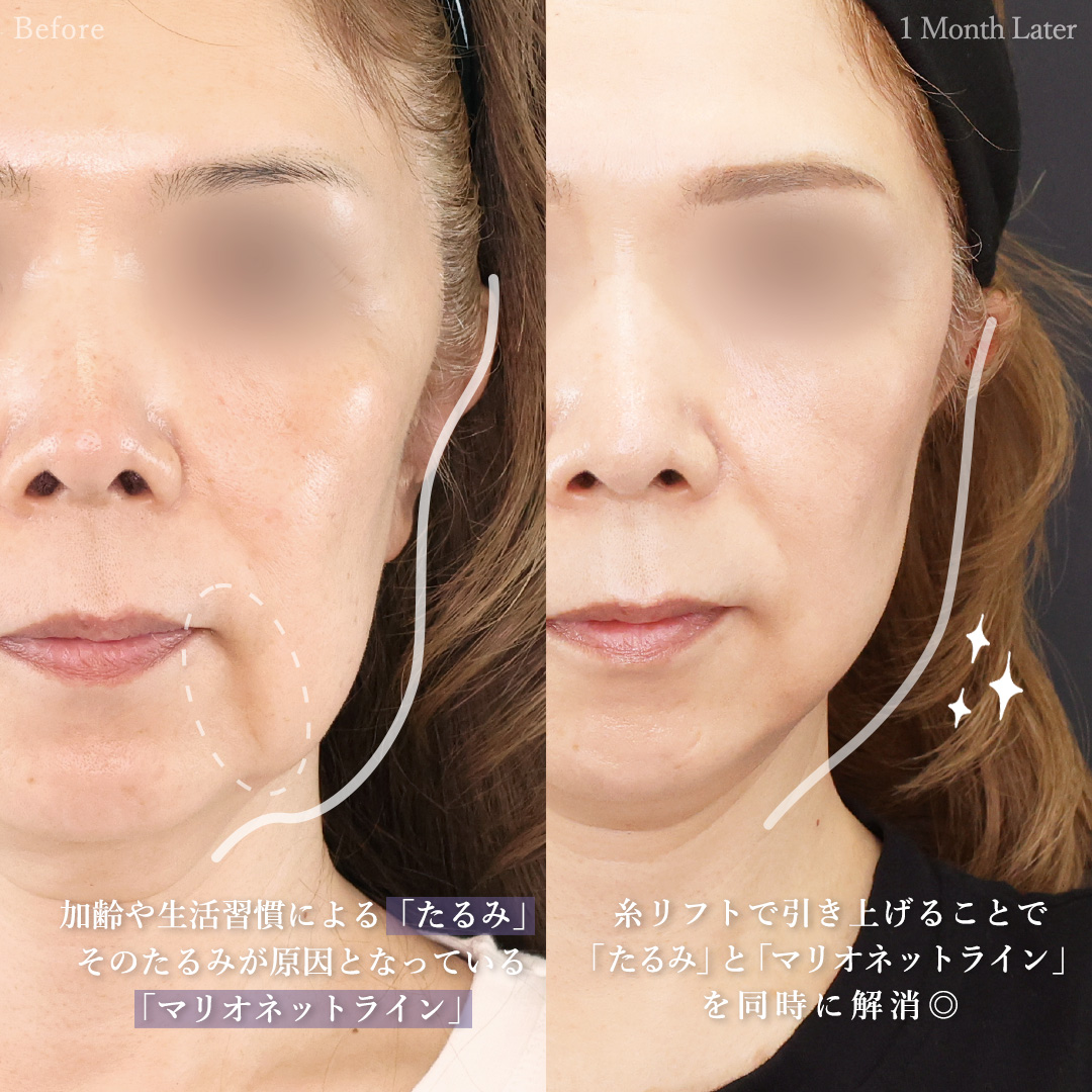 TAC式 ツヤ肌コラーゲンリフト®/Lラインファット除去（エラ下脂肪除去）/ボトックス注射：その他の症例写真 施術前後 
