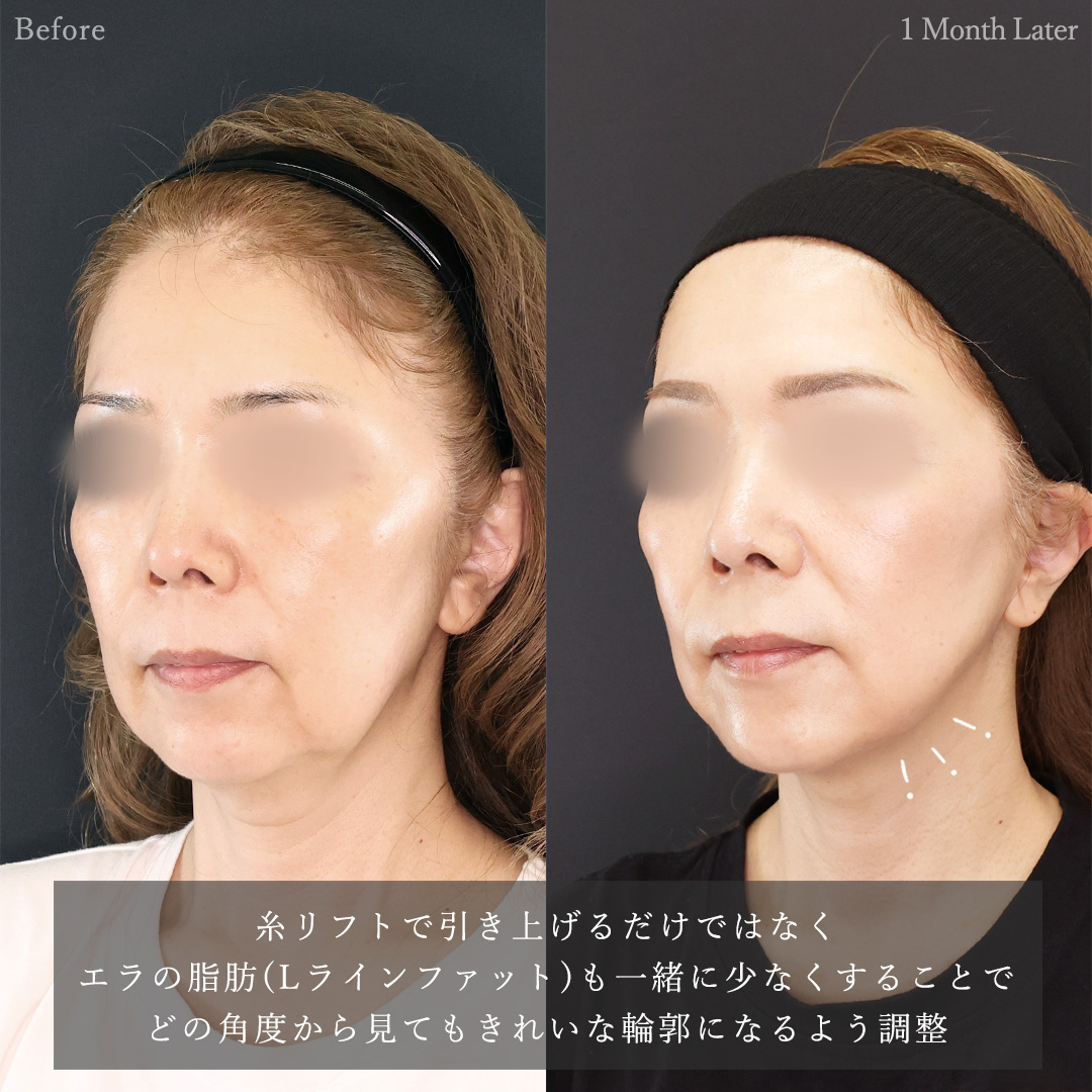 TAC式 ツヤ肌コラーゲンリフト®/Lラインファット除去（エラ下脂肪除去）/ボトックス注射：その他の症例写真 施術前後 