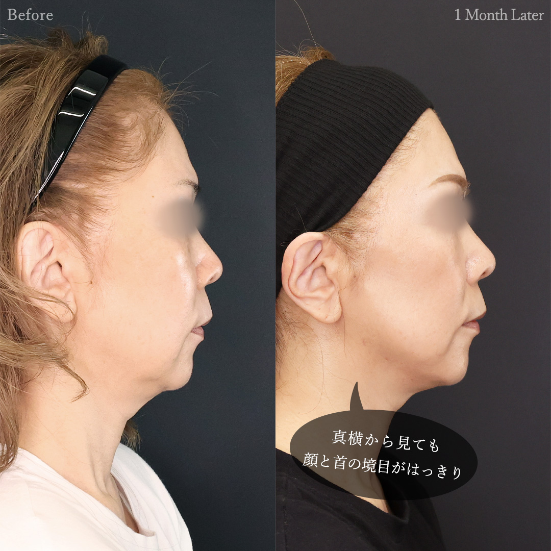 TAC式 ツヤ肌コラーゲンリフト®/Lラインファット除去（エラ下脂肪除去）/ボトックス注射：その他の症例写真 施術前後 