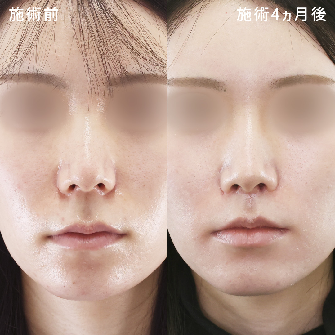 【人中短縮術】気になる鼻の下を短くしバランス良く