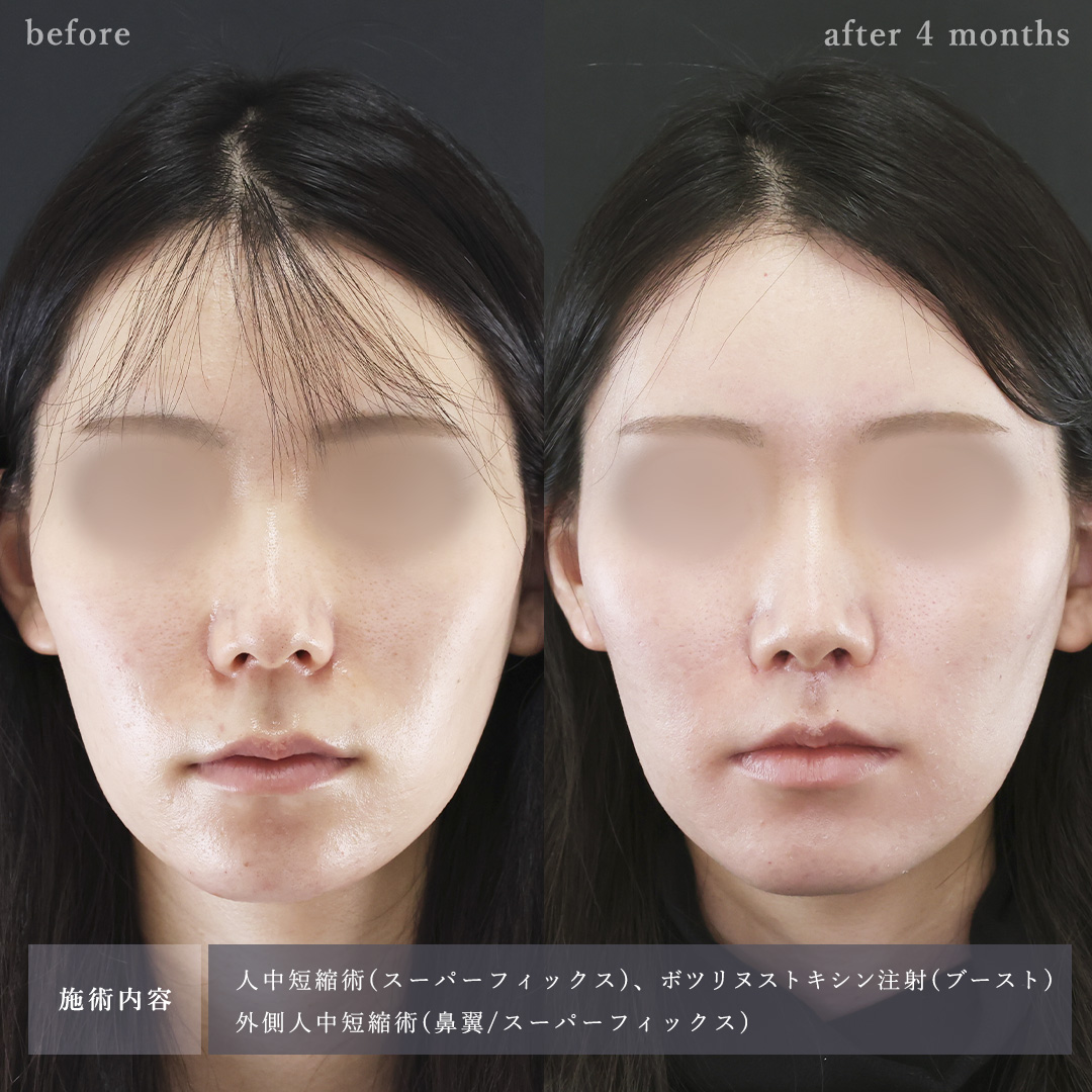 人中短縮術(リップリフト)・外側人中短縮術/ボトックス注射：その他の症例写真 施術前後 