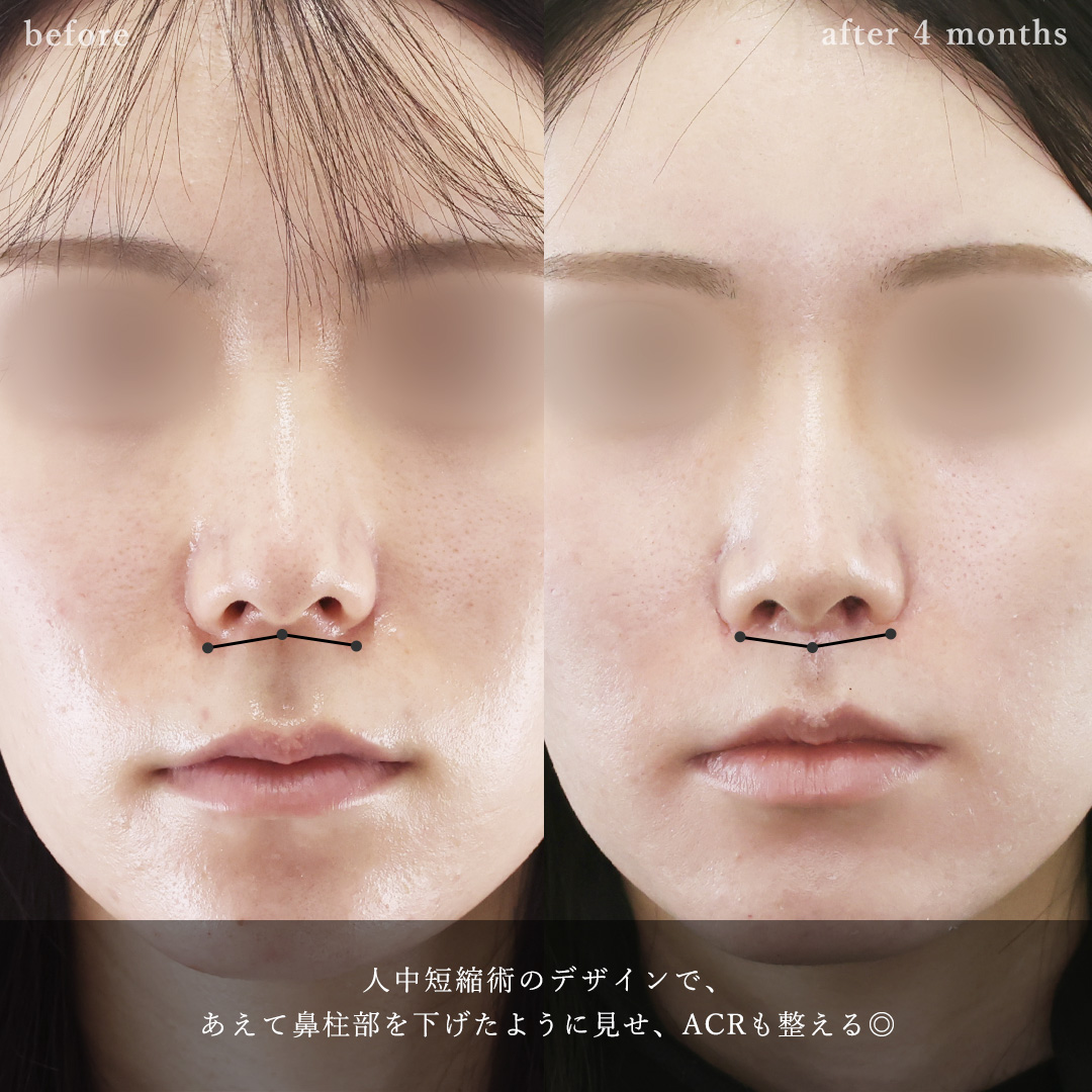 人中短縮術(リップリフト)・外側人中短縮術/ボトックス注射：その他の症例写真 施術前後 