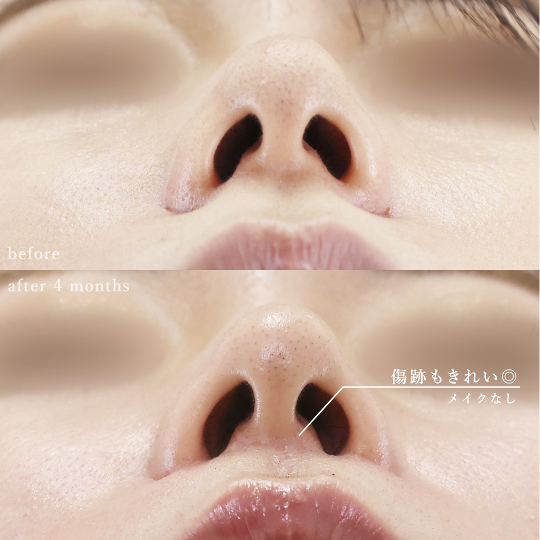 人中短縮術(リップリフト)・外側人中短縮術/ボトックス注射：その他の症例写真 施術前後 