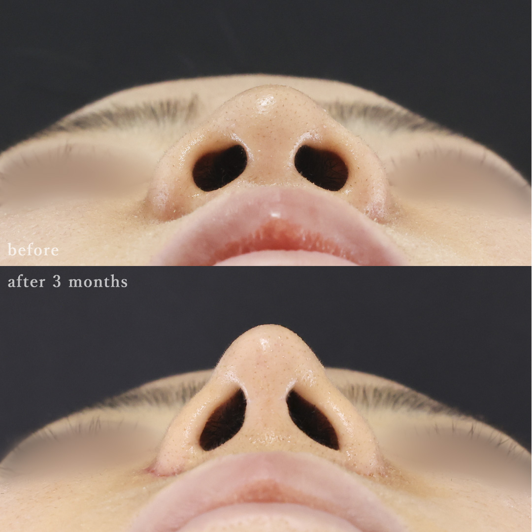 鼻中隔延長術/鼻尖形成・鼻尖縮小/鼻先軟骨移植の症例写真 施術前後