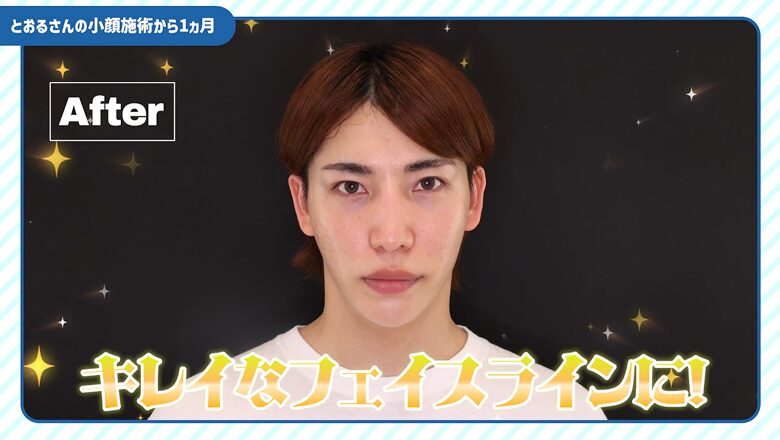 施術1カ月後の正面写真