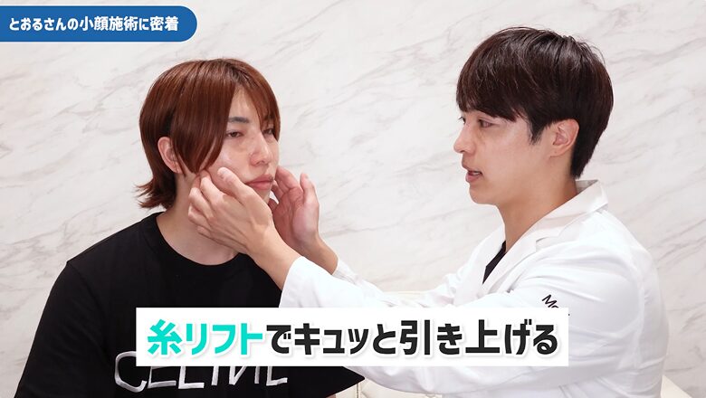 糸リフトによる引き上げ効果について説明